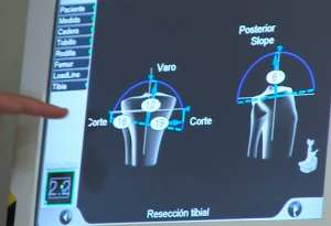 El papel de la enfermería en la artroplastia de rodilla