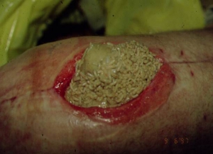 Larvas sobre una herida