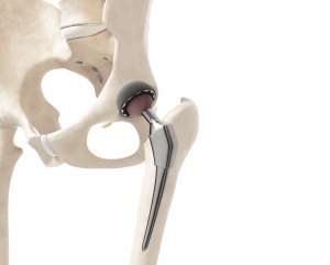 Charlas enfermeras para ayudar a pacientes a punto de operarse de prótesis de cadera o rodilla