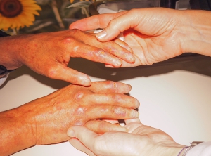 Una nueva gu&iacute;a de pr&aacute;ctica cl&iacute;nica busca estandarizar la atenci&oacute;n enfermera a los pacientes con esclerodermia, una dolencia que afecta a m&aacute;s 13.000 espa&ntilde;oles