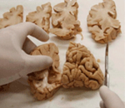 400 donaciones de tejido cerebral para investigar en neurodegeneración 