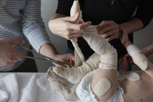 Los pacientes con “piel de mariposa” podrán conseguir gratis su material de cura en los centros de salud
